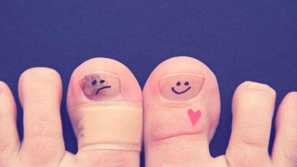 paznokieć z grzybem i zdrowy